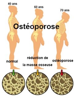 L'ostéoporose : prévention et conseils pratiques
